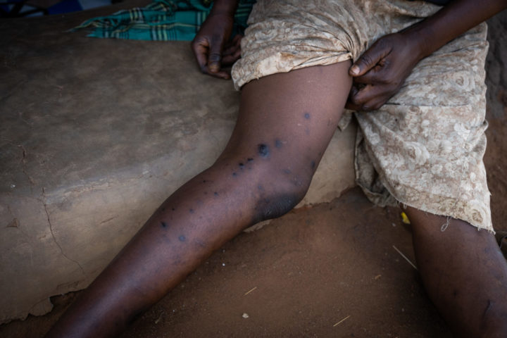 Woman showing her leg, which is full of black, round wounds.